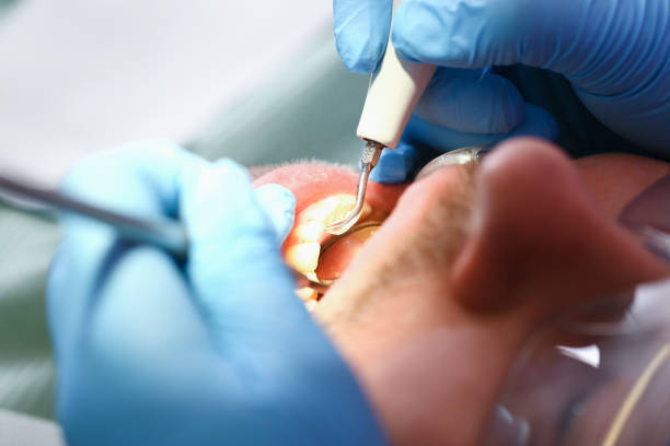 Best Emergency Wisdom Teeth Removal in Quincy, CA